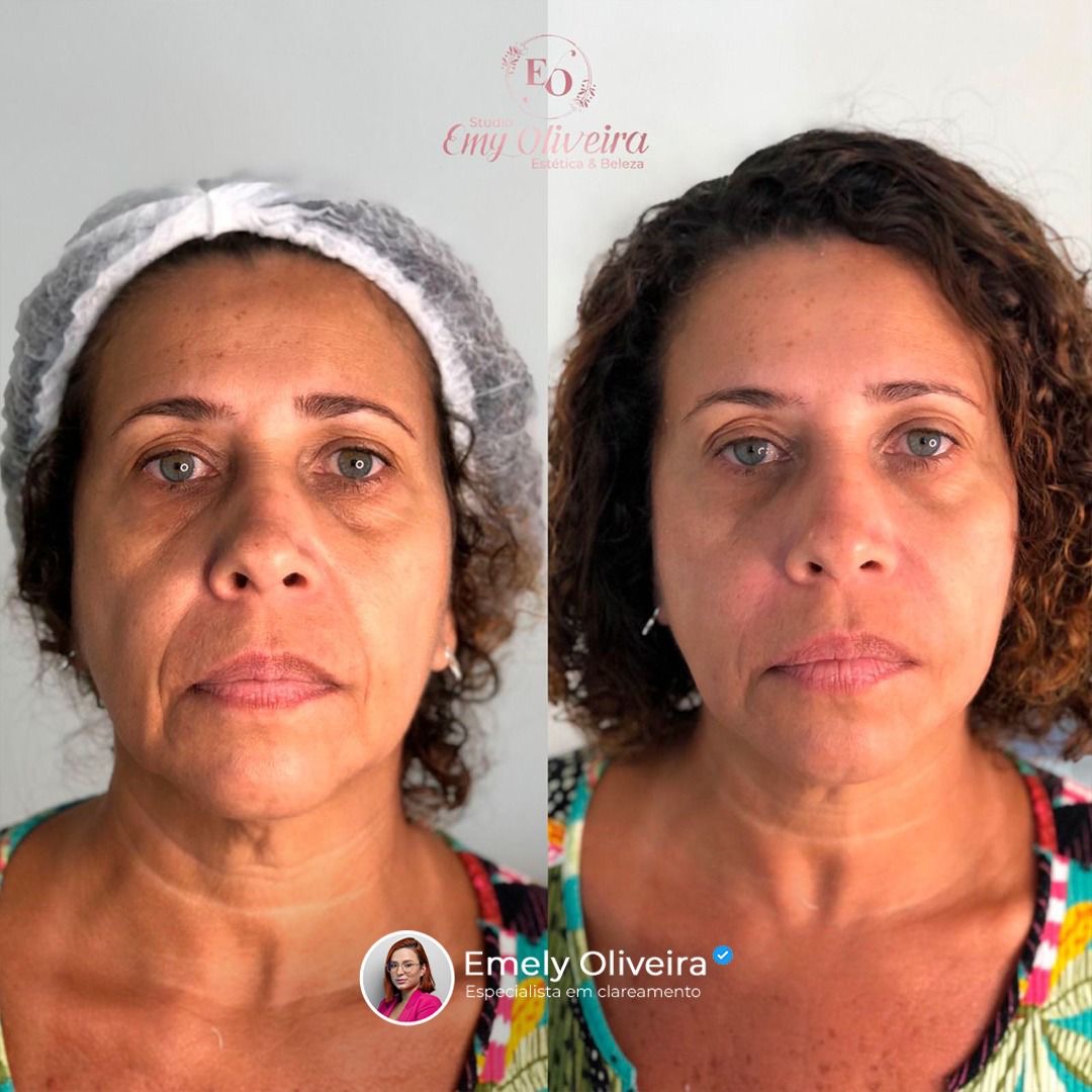 Rejuvenescimento Facial